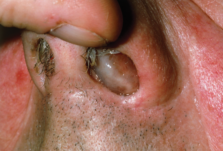 Everything to Know About Nasal Polyposis!